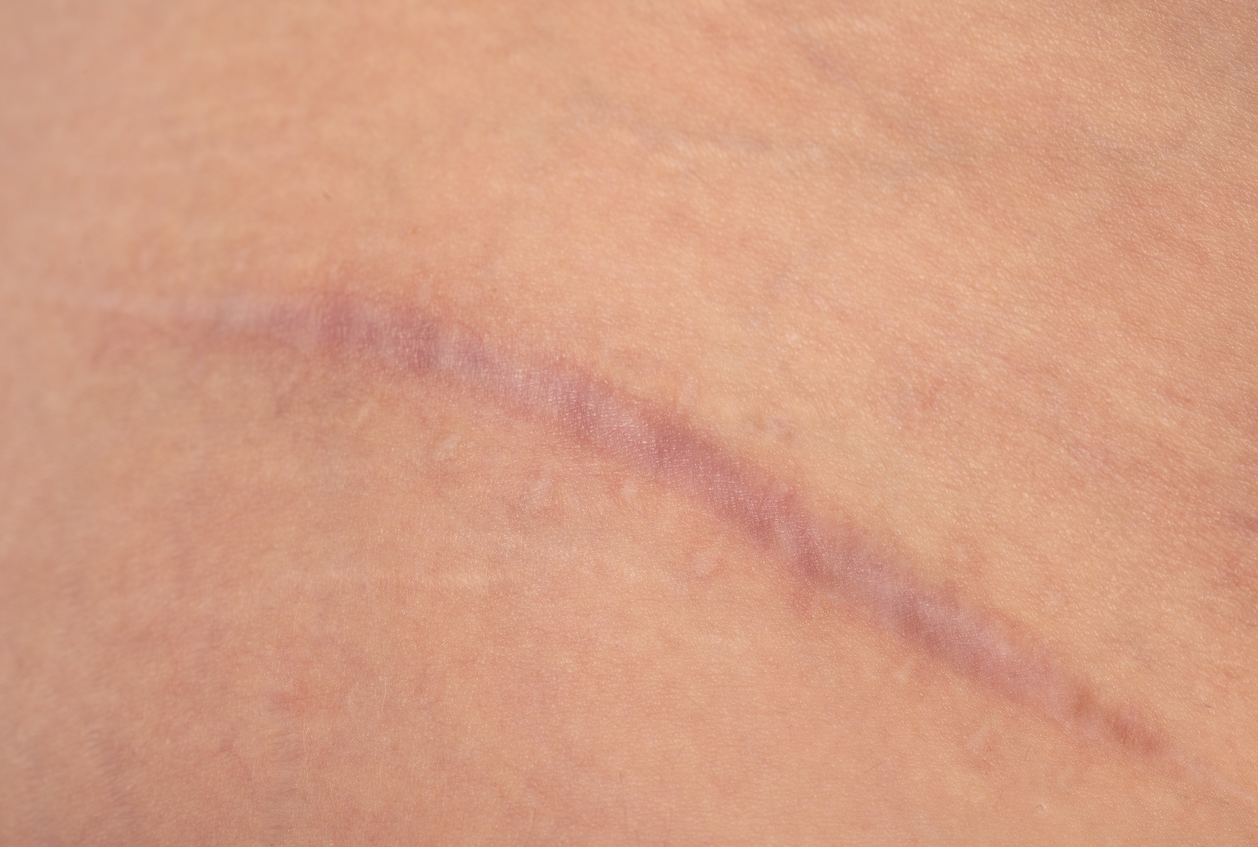 DER DERMATOLOGISCHE LEITFADEN ZUR NARBENHEILUNG